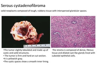 Serous cystadenofibroma
•The tumor slightly lobulated and made up of
cystic and solid structures.
• The tumor is firm and hard on cut section.
•It is yellowish gray.
•The cystic spaces show a smooth inner lining.
The stroma is composed of dense, fibrous
tissue and dilated cyst-like glands lined with
cuboidal epithelial cells.
solid neoplasms composed of tough, rubbery tissue with interspersed glandular spaces.
 