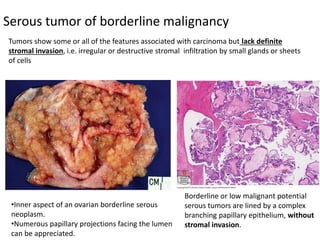 Serous tumor of borderline malignancy
•Inner aspect of an ovarian borderline serous
neoplasm.
•Numerous papillary projections facing the lumen
can be appreciated.
Borderline or low malignant potential
serous tumors are lined by a complex
branching papillary epithelium, without
stromal invasion.
Tumors show some or all of the features associated with carcinoma but lack definite
stromal invasion, i.e. irregular or destructive stromal infiltration by small glands or sheets
of cells
 