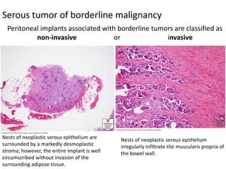 Serous tumor of borderline malignancy
Peritoneal implants associated with borderline tumors are classified as
non-invasive or invasive
Nests of neoplastic serous epithelium are
surrounded by a markedly desmoplastic
stroma; however, the entire implant is well
circumscribed without invasion of the
surrounding adipose tissue.
Nests of neoplastic serous epithelium
irregularly infiltrate the muscularis propria of
the bowel wall.
 
