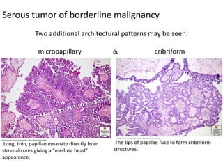 Serous tumor of borderline malignancy
Two additional architectural patterns may be seen:
micropapillary & cribriform
Long, thin, papillae emanate directly from
stromal cores giving a “medusa head”
appearance.
The tips of papillae fuse to form cribriform
structures.
 
