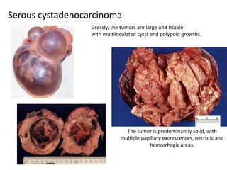 Serous cystadenocarcinoma
The tumor is predominantly solid, with
multiple papillary excrescences, necrotic and
hemorrhagic areas.
Grossly, the tumors are large and friable
with multiloculated cysts and polypoid growths.
 