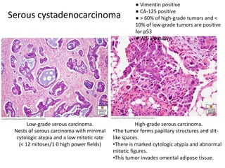Serous cystadenocarcinoma
Low-grade serous carcinoma.
Nests of serous carcinoma with minimal
cytologic atypia and a low mitotic rate
(< 12 mitoses/1 0 high power fields)
High-grade serous carcinoma.
•The tumor forms papillary structures and slit-
like spaces.
•There is marked cytologic atypia and abnormal
mitotic figures.
•This tumor invades omental adipose tissue.
● Vimentin positive
● CA-125 positive
● > 60% of high-grade tumors and <
10% of low-grade tumors are positive
for p53
● WT-1 positive
 