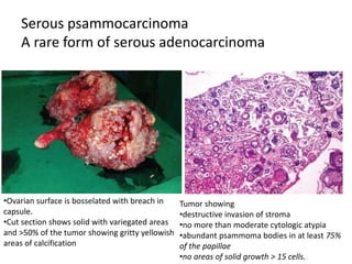 Serous psammocarcinoma
A rare form of serous adenocarcinoma
•Ovarian surface is bosselated with breach in
capsule.
•Cut section shows solid with variegated areas
and >50% of the tumor showing gritty yellowish
areas of calcification
Tumor showing
•destructive invasion of stroma
•no more than moderate cytologic atypia
•abundant psammoma bodies in at least 75%
of the papillae
•no areas of solid growth > 15 cells.
 