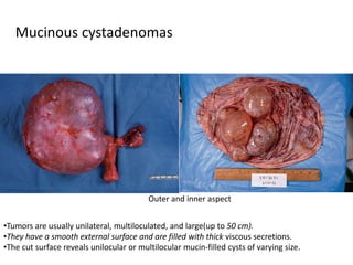 Mucinous cystadenomas
•Tumors are usually unilateral, multiloculated, and large(up to 50 cm).
•They have a smooth external surface and are filled with thick viscous secretions.
•The cut surface reveals unilocular or multilocular mucin-filled cysts of varying size.
Outer and inner aspect
 