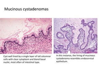 Mucinous cystadenomas
Cyst wall lined by a single layer of tall columnar
cells with clear cytoplasm and bland basal
nuclei, most often of intestinal type.
In this instance, the lining of mucinous
cystadenoma resembles endocervical
epithelium.
 
