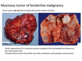 Mucinous tumor of borderline malignancy
•Gross appearance of a mucinous ovarian neoplasm that had borderline features at
the microscopic level.
•Grossly, these tumors have thick cyst walls sometimes with papillary excrescences.
These tumors do not demonstrate destructive stromal invasion.
 