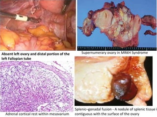 Adrenal cortical rest within mesovarium
Splenic–gonadal fusion - A nodule of splenic tissue i
contiguous with the surface of the ovary
Supernumerary ovary in MRKH SyndromeAbsent left ovary and distal portion of the
left Fallopian tube
 