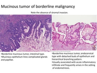 Mucinous tumor of borderline malignancy
•Borderline mucinous tumor, intestinal type.
•Mucinous epithelium lines complicated glands
and papillae.
•Borderline mucinous tumor, endocervical
type with detached buds of epithelium and
hierarchical branching pattern.
•Usually associated with acute inflammatory
infiltrate and frequently arises in the setting
of endometriosis.
Note the absence of stromal invasion.
 