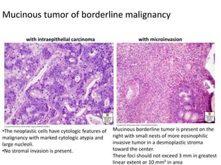 Mucinous tumor of borderline malignancy
with intraepithelial carcinoma with microinvasion
•The neoplastic cells have cytologic features of
malignancy with marked cytologic atypia and
large nucleoli.
•No stromal invasion is present.
Mucinous borderline tumor is present on the
right with small nests of more eosinophilic
invasive tumor in a desmoplastic stroma
toward the center.
These foci should not exceed 3 mm in greatest
linear extent or 10 mm² in area
 