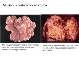 Mucinous cystadenocarcinoma
The tumor is predominantly solid, but some
mucin-containing cystic spaces can still be
appreciated.
The ovary is replaced by a solid, haemorrhagic
mass composed of multiple papillae and
locules, containing viscid fluid.
 