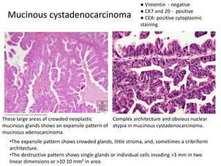 Mucinous cystadenocarcinoma
These large areas of crowded neoplastic
mucinous glands shows an expansile pattern of
mucinous adenocarcinoma
Complex architecture and obvious nuclear
atypia in mucinous cystadenocarcinoma.
•The expansile pattern shows crowded glands, little stroma, and, sometimes a cribriform
architecture.
•The destructive pattern shows single glands or individual cells invading >3 mm in two
linear dimensions or >10 10 mm² in area.
● Vimentin - negative
● CK7 and 20 - positive
● CEA: positive cytoplasmic
staining
 