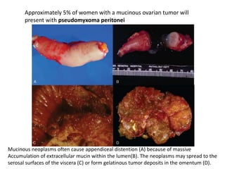 Approximately 5% of women with a mucinous ovarian tumor will
present with pseudomyxoma peritonei
Mucinous neoplasms often cause appendiceal distention (A) because of massive
Accumulation of extracellular mucin within the lumen(B). The neoplasms may spread to the
serosal surfaces of the viscera (C) or form gelatinous tumor deposits in the omentum (D).
 