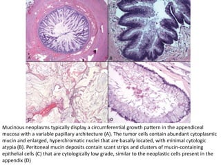 Mucinous neoplasms typically display a circumferential growth pattern in the appendiceal
mucosa with a variable papillary architecture (A). The tumor cells contain abundant cytoplasmic
mucin and enlarged, hyperchromatic nuclei that are basally located, with minimal cytologic
atypia (B). Peritoneal mucin deposits contain scant strips and clusters of mucin-containing
epithelial cells (C) that are cytologically low grade, similar to the neoplastic cells present in the
appendix (D)
 