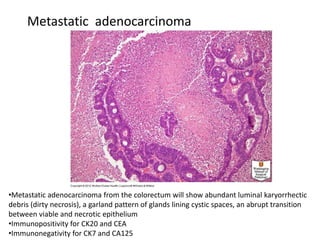 •Metastatic adenocarcinoma from the colorectum will show abundant luminal karyorrhectic
debris (dirty necrosis), a garland pattern of glands lining cystic spaces, an abrupt transition
between viable and necrotic epithelium
•Immunopositivity for CK20 and CEA
•Immunonegativity for CK7 and CA125
Metastatic adenocarcinoma
 
