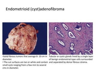 Endometrioid (cyst)adenofibroma
•Solid fibrous tumors that average 8- 10 cm in
diameter.
• The cut surfaces are tan or white and contain
small cysts ranging from a few mm to several
cms in diameter.
Tubular or cystic glands lined by a single layer
of benign endometrial-type cells surrounded
and separated by dense fibrous stroma.
 