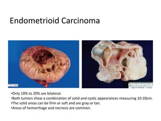 Endometrioid Carcinoma
•Only 10% to 20% are bilateral.
•Both tumors show a combination of solid and cystic appearances measuring 10-20cm.
•The solid areas can be firm or soft and are gray or tan.
•Areas of hemorrhage and necrosis are common.
 