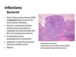Infections
Bacterial
• Pelvic inflammatory disease (PID)
of bacterial origin accounts for
most ovarian infections.
• Ovarian involvement by PID is
almost always secondary to
salpingitis and typically takes the
form of a tuboovarian abscess.
• A mixed flora with a
preponderance of anaerobic
• organisms is typically recovered
from the contents of the
• abscess
Tuboovarian abscess.
Lining consists of inflammatory debris
with subjacent granulation tissue
 
