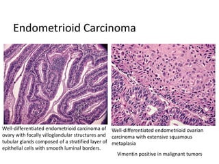 Endometrioid Carcinoma
Well-differentiated endometrioid carcinoma of
ovary with focally villoglandular structures and
tubular glands composed of a stratified layer of
epithelial cells with smooth luminal borders.
Well-differentiated endometrioid ovarian
carcinoma with extensive squamous
metaplasia
Vimentin positive in malignant tumors
 