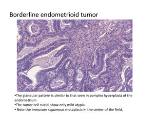 Borderline endometrioid tumor
•The glandular pattern is similar to that seen in complex hyperplasia of the
endometrium.
•The tumor cell nuclei show only mild atypia.
• Note the immature squamous metaplasia in the center of the field.
 