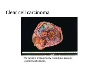 Clear cell carcinoma
The tumor is predominantly cystic, but it contains
several mural nodules.
 