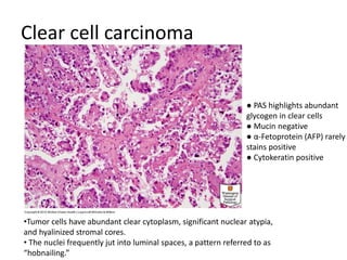 Clear cell carcinoma
•Tumor cells have abundant clear cytoplasm, significant nuclear atypia,
and hyalinized stromal cores.
• The nuclei frequently jut into luminal spaces, a pattern referred to as
“hobnailing.”
● PAS highlights abundant
glycogen in clear cells
● Mucin negative
● α-Fetoprotein (AFP) rarely
stains positive
● Cytokeratin positive
 