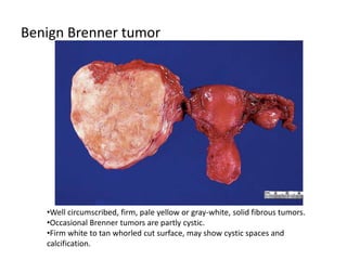 Benign Brenner tumor
•Well circumscribed, firm, pale yellow or gray-white, solid fibrous tumors.
•Occasional Brenner tumors are partly cystic.
•Firm white to tan whorled cut surface, may show cystic spaces and
calcification.
 