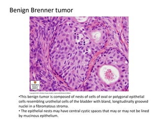 Benign Brenner tumor
•This benign tumor is composed of nests of cells of oval or polygonal epithelial
cells resembling urothelial cells of the bladder with bland, longitudinally grooved
nuclei in a fibromatous stroma.
• The epithelial nests may have central cystic spaces that may or may not be lined
by mucinous epithelium.
 