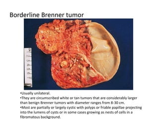 Borderline Brenner tumor
•Usually unilateral.
•They are circumscribed white or tan tumors that are considerably larger
than benign Brenner tumors with diameter ranges from 8-30 cm.
•Most are partially or largely cystic with polyps or friable papillae projecting
into the lumens of cysts or in some cases growing as nests of cells in a
fibromatous background.
 