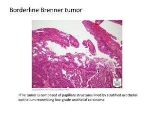 Borderline Brenner tumor
•The tumor is composed of papillary structures lined by stratified urothelial
epithelium resembling low-grade urothelial carcinoma
 