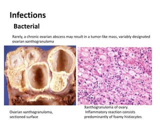 Infections
Bacterial
Xanthogranuloma of ovary.
Inflammatory reaction consists
predominantly of foamy histiocytes
Ovarian xanthogranuloma,
sectioned surface
Rarely, a chronic ovarian abscess may result in a tumor-like mass, variably designated
ovarian xanthogranuloma
 