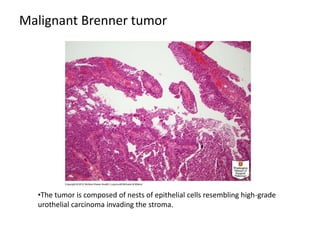 Malignant Brenner tumor
•The tumor is composed of nests of epithelial cells resembling high-grade
urothelial carcinoma invading the stroma.
 