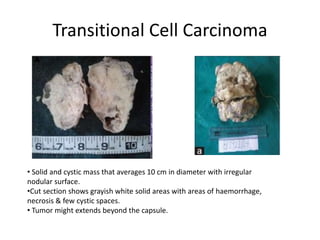 Transitional Cell Carcinoma
• Solid and cystic mass that averages 10 cm in diameter with irregular
nodular surface.
•Cut section shows grayish white solid areas with areas of haemorrhage,
necrosis & few cystic spaces.
• Tumor might extends beyond the capsule.
 
