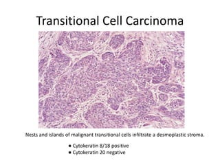 Transitional Cell Carcinoma
Nests and islands of malignant transitional cells infiltrate a desmoplastic stroma.
● Cytokeratin 8/18 positive
● Cytokeratin 20 negative
 