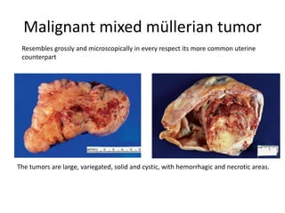Malignant mixed müllerian tumor
Resembles grossly and microscopically in every respect its more common uterine
counterpart
The tumors are large, variegated, solid and cystic, with hemorrhagic and necrotic areas.
 