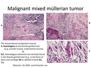 Malignant mixed müllerian tumor
The mesenchymal component may be
A. homologous to the female genital tract
(e.g.,smooth muscle, endometrial stroma)
Or
B,C. heterologous elements not normally found
in the female genital tract {e.g., in the form of
bone and cartilage (B) or skeletal muscle (C) ,
fat}
A
B
C
Reticulin, CK, EMA and Vimentin +ve
 