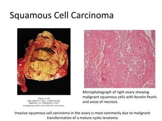 Squamous Cell Carcinoma
Invasive squamous cell carcinoma in the ovary is most commonly due to malignant
transformation of a mature cystic teratoma
Microphotograph of right ovary showing
malignant squamous cells with Keratin Pearls
and areas of necrosis.
 