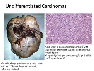 Undifferentiated Carcinomas
•Grossly, a large, predominantly solid tumor
with foci of hemorrhage and necrosis.
•Most are bilateral.
•Solid sheet of anaplastic malignant cells with
large nuclei, prominent nucleoli, and numerous
mitotic figures.
•Frequently show positive staining for p16, WT-1
and frequently for p53
 