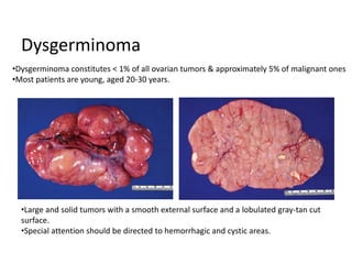 Dysgerminoma
•Large and solid tumors with a smooth external surface and a lobulated gray-tan cut
surface.
•Special attention should be directed to hemorrhagic and cystic areas.
•Dysgerminoma constitutes < 1% of all ovarian tumors & approximately 5% of malignant ones
•Most patients are young, aged 20-30 years.
 