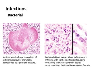 Infections
Bacterial
Malacoplakia of ovary - Mixed inflammatory
infiltrate with epithelioid histiocytes, some
containing Michaelis–Guttman bodies.
Associated with E coli and Enterococcus faecalis.
Actinomycosis of ovary - A colony of
actinomyces (sulfur granule) is
surrounded by a purulent exudate.
 