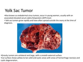 Yolk Sac Tumor
•Grossly, tumors are unilateral and large, with a smooth external surface.
•Cut surface shows yellow to tan solid and cystic areas with areas of hemorrhage necrosis and
cystic degeneration.
•Also known as endodermal sinus tumors, occur in young women, usually with an
associated elevated serum alpha fetoprotein (AFP) level.
• Yolk sac tumors grow rapidly and have often spread outside the ovary at the time of
diagnosis.
 
