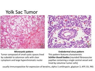 Yolk Sac Tumor
Microcystic pattern
Tumor composed of small cystic spaces lined
by cuboidal to columnar cells with clear
cytoplasm and large hyperchromatic nuclei
Endodermal sinus pattern
This pattern features characteristic
Schiller-Duvall bodies (rounded fibrovascular
papillae containing a single central vessel and
lined by columnar tumor cells)
usually immunopositive for expression of keratins, alpha-1-antitrypsin, glypican 3, AFP, CK, PAS
 