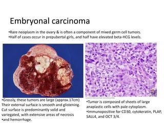 Embryonal carcinoma
•Grossly, these tumors are large (approx.17cm)
Their external surface is smooth and glistening.
Cut surface is predominantly solid and
variegated, with extensive areas of necrosis
•and hemorrhage.
•Rare neoplasm in the ovary & is often a component of mixed germ cell tumors.
•Half of cases occur in prepubertal girls, and half have elevated beta-HCG levels.
•Tumor is composed of sheets of large
anaplastic cells with pale cytoplasm.
•Immunopositive for CD30, cytokeratin, PLAP,
SALL4, and OCT 3/4.
 