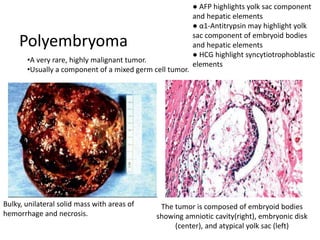 Polyembryoma
Bulky, unilateral solid mass with areas of
hemorrhage and necrosis.
The tumor is composed of embryoid bodies
showing amniotic cavity(right), embryonic disk
(center), and atypical yolk sac (left)
•A very rare, highly malignant tumor.
•Usually a component of a mixed germ cell tumor.
● AFP highlights yolk sac component
and hepatic elements
● α1-Antitrypsin may highlight yolk
sac component of embryoid bodies
and hepatic elements
● HCG highlight syncytiotrophoblastic
elements
 