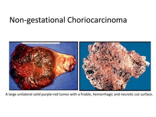 Non-gestational Choriocarcinoma
A large unilateral solid purple-red tumor with a friable, hemorrhagic and necrotic cut surface.
 