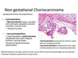 Non-gestational Choriocarcinoma
composed of two cell populations :
• Cytotrophoblast
– Mononucleated, large, rounded
cells with pale cytoplasm present
centrally in tumor mass
– Positive for hCG
• • Syncytiotrophoblast
– Large basophilic, multinucleated,
vacuolated cells with irregular
outlines, varying shape.
– Nuclei are hyperchromatic,
pleomorphic
•Dilated vascular sinusoids, which are the source of the massive hemorrhage are also present.
• Vascular invasion is prominent in some cases
•Cytotrophoblast composed of medium-sized
cells are situated centrally
•Syncytiotrophoblast composed of very large
multinucleated cells are situated peripherally
 