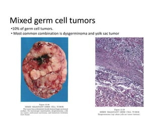 Mixed germ cell tumors
•10% of germ cell tumors.
• Most common combination is dysgerminoma and yolk sac tumor
 