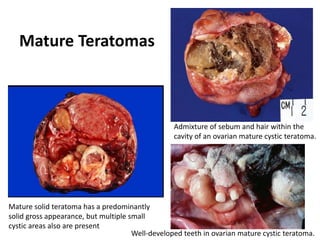 Mature Teratomas
Mature solid teratoma has a predominantly
solid gross appearance, but multiple small
cystic areas also are present
Well-developed teeth in ovarian mature cystic teratoma.
Admixture of sebum and hair within the
cavity of an ovarian mature cystic teratoma.
 
