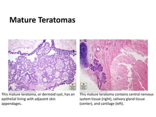 Mature Teratomas
This mature teratoma, or dermoid cyst, has an
epithelial lining with adjacent skin
appendages.
This mature teratoma contains central nervous
system tissue (right), salivary gland tissue
(center), and cartilage (left).
 