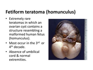 Fetiform teratoma (homunculus)
• Extremely rare
teratomas in which an
ovarian cyst contains a
structure resembling a
malformed human fetus
(homunculus).
• Most occur in the 3rd or
4th decade.
• Absence of umbilical
cord & normal
extremities.
 