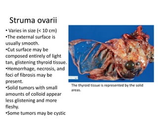 Struma ovarii
• Varies in size (< 10 cm)
•The external surface is
usually smooth.
•Cut surface may be
composed entirely of light
tan, glistening thyroid tissue.
•Hemorrhage, necrosis, and
foci of fibrosis may be
present.
•Solid tumors with small
amounts of colloid appear
less glistening and more
fleshy.
•Some tumors may be cystic
The thyroid tissue is represented by the solid
areas.
 